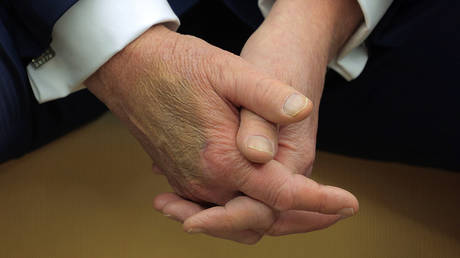 FILE PHOTO: Makeup covers a bruise on the back of US President Donald Trump's hand on February 24, 2025 in Washington, DC.